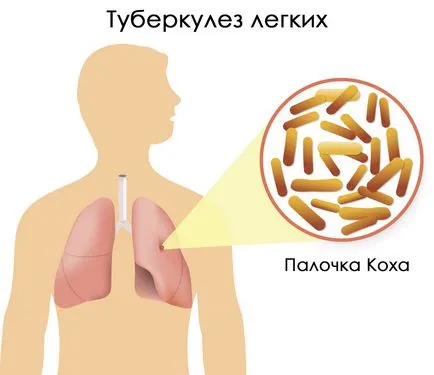 A zárt forma tuberkulózis, hogy ez