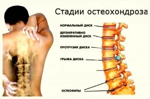 Кои са признаците на остеохондроза