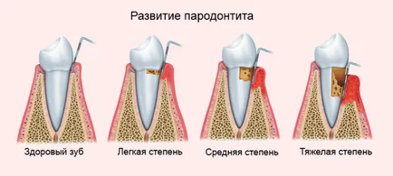 Пародонтит медицинска история Пародонтит медицинска история