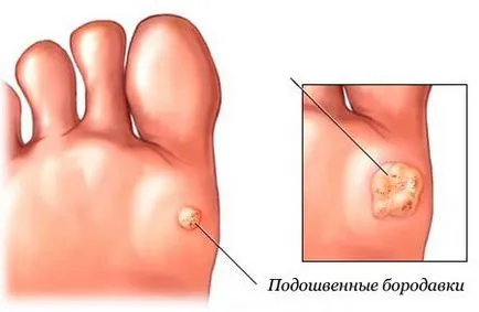 Как да се отървете от брадавици