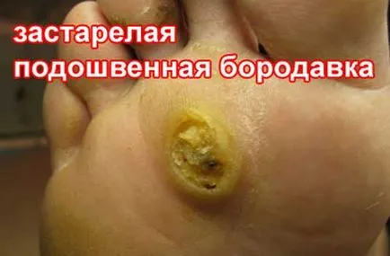 Как да се отървете от брадавици