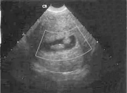 Hysteroresectoscopy какво е
