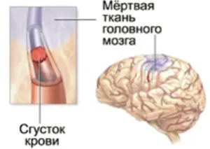 втори инсулт