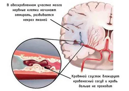 втори инсулт