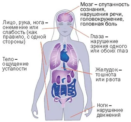 втори инсулт