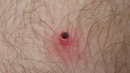 Как да определите ухапването от кърлеж
