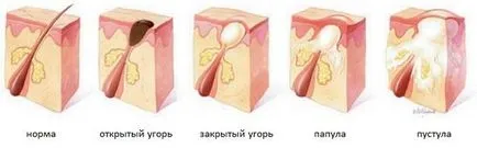 Пустули какво е