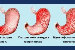 Смесен гастрит какво е