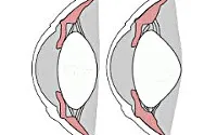 Какво е cyclospasm