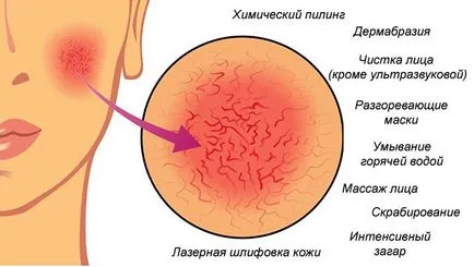 Как да се отървем от съдови звездички