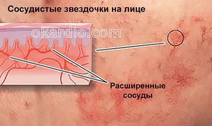 Как да се отървем от съдови звездички