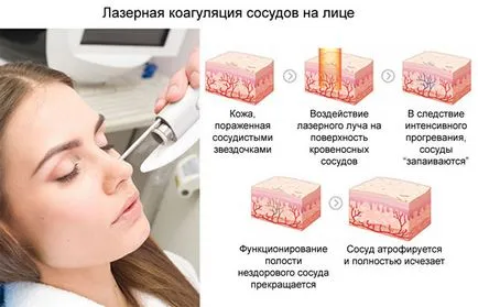 Как да се отървем от съдови звездички