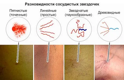 Как да се отървем от съдови звездички