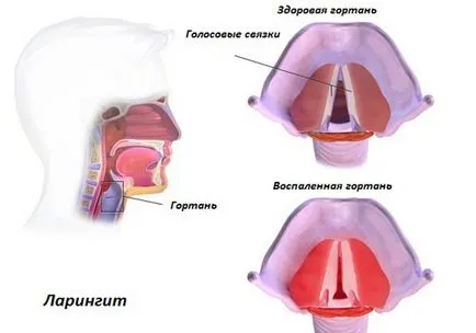 Детето е с дрезгав глас лечение