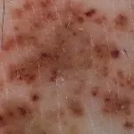 то васкулит