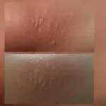 Дете на лакти, като обрив