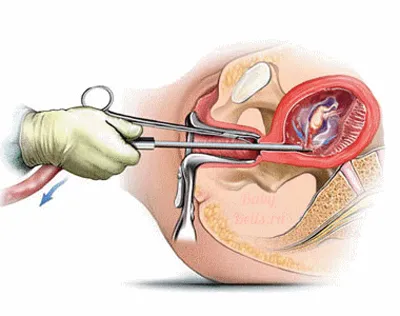 гинекологични кюртаж гинекологични кюртаж