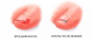 Какво да правим с ноктите на краката