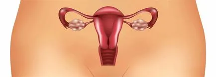 възпаление, лечение на придатъци