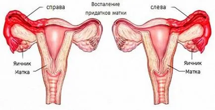 възпаление, лечение на придатъци