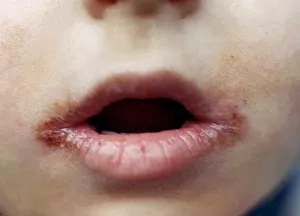 лечение Зайед на дете лечение Зайед на дете