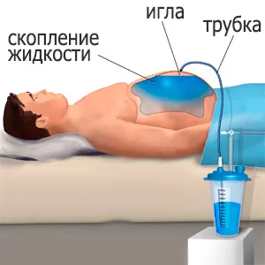 От което течността в корема