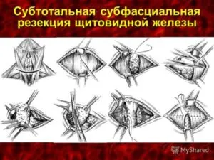 Аденом на щитовидната симптоми, диагностика, лечение (простата) Щитовидната жлеза аденом симптоми, диагностика, лечение