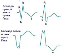 Бедрен блок - причини, симптоми, диагностика и лечение
