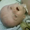 Какво е церебрална парализа (CP) в детските симптоми и причини (децата на мозъка) Какво е церебрална парализа (CP) в детските симптоми и причини