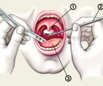 Какво е pharyngoscope гърлото видове медицина, индикации за изследване