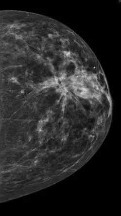 Дифузната fibroadenomatosis Причини гърдата и Лечение