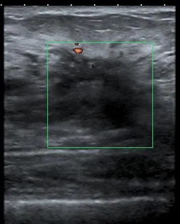Дифузната fibroadenomatosis Причини гърдата и Лечение