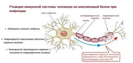 Демиелинизиращо заболяване на мозъка, че е, демиелинизация огнища в мозъка