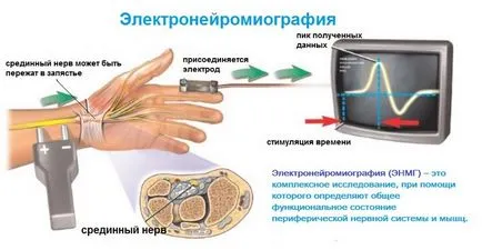Демиелинизиращо заболяване на мозъка, че е, демиелинизация огнища в мозъка