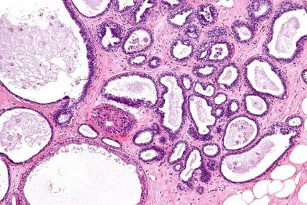 Дифузната fibroadenomatosis Причини гърдата и Лечение