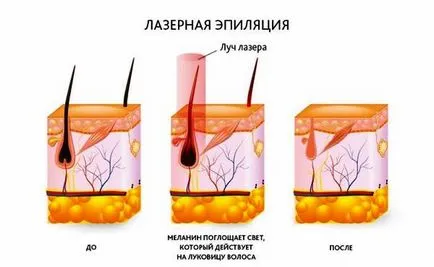 Премахване на окосмяване и кола маска след раждането