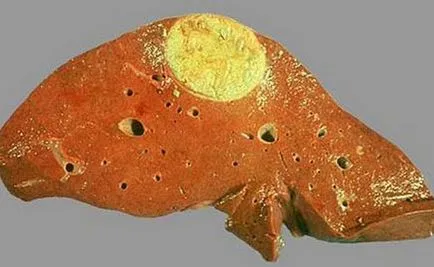 Echinococcus и хидатидоза заболяване лечение при деца и възрастни (деца) Ехинококоза и ехинококоза лечение при деца и възрастни