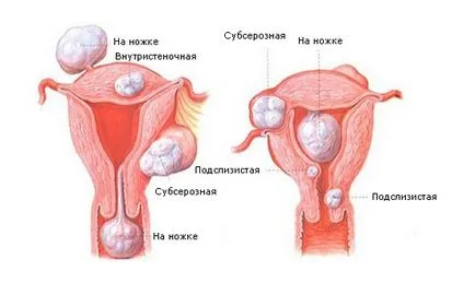 миома на матката причини, признаци и симптоми, лечение