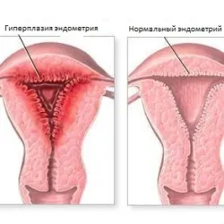 Ендометриума, симптоми и лечение на народната медицина хиперплазия