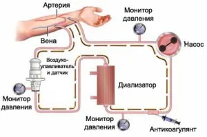 Хемодиализа - в някои случаи е необходимо и каква е процедурата