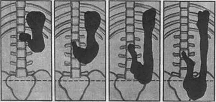Gastroptosis причинява симптоми, лечение