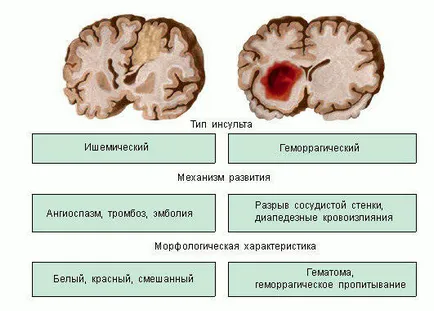 Хеморагични церебрални симптоми инсулт, ефекти и лечение