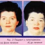 Хипотиреоидизъм и диабет, ако една връзка между заболяванията на щитовидната жлеза и нивото на