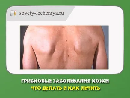 Гъбични заболявания на кожата, какво да правят и как да се отнасяме