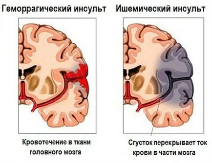 Правилните последствията полукълбо инсулт - лечение на сърдечна