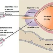 Как е подготовка ултразвук простатата простатата