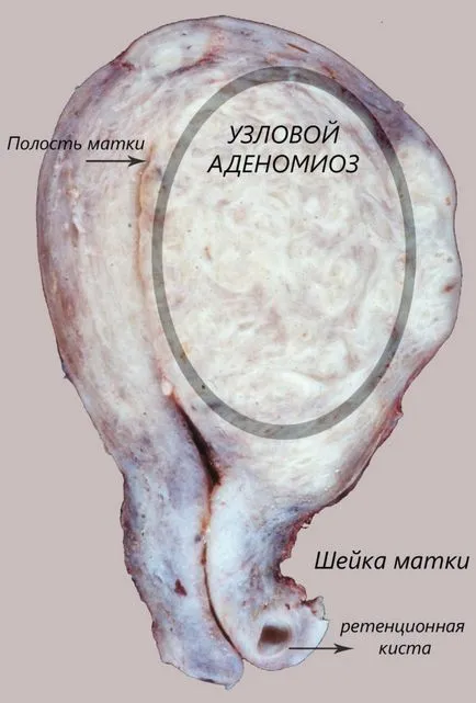 méh adenomió hogy érthető nyelven képpel