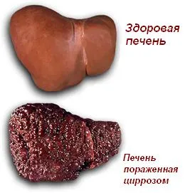 Alkoholos májbetegség tünetek és a kezelés (tünetek) Alkoholos májbetegség tünetek és a kezelés