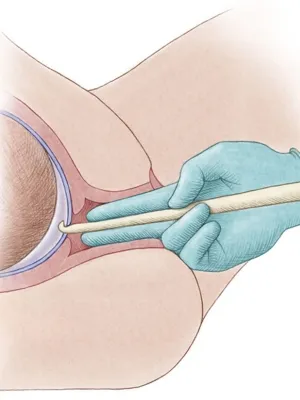 Amniotomy - szúrt membránok - születés, a születés után