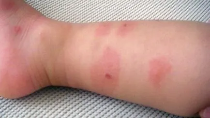 Allergiás a csípése poloska gyermekek és felnőttek hogyan kell nézni, és hogyan kell kezelni